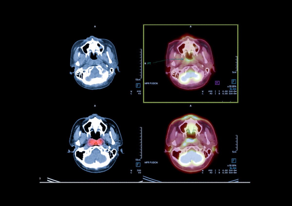 PET CT image of the brain showing CA nasopharynx or carcinoma of nasopharynx from PET CT scannner.